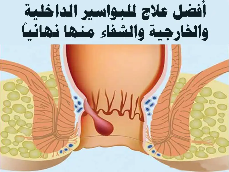 علاج البواسير الداخلية والخارجية موضوع شامل 2021